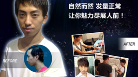 【发际线后移】有没有 差很多！ 头发真的是男人们的第二张脸