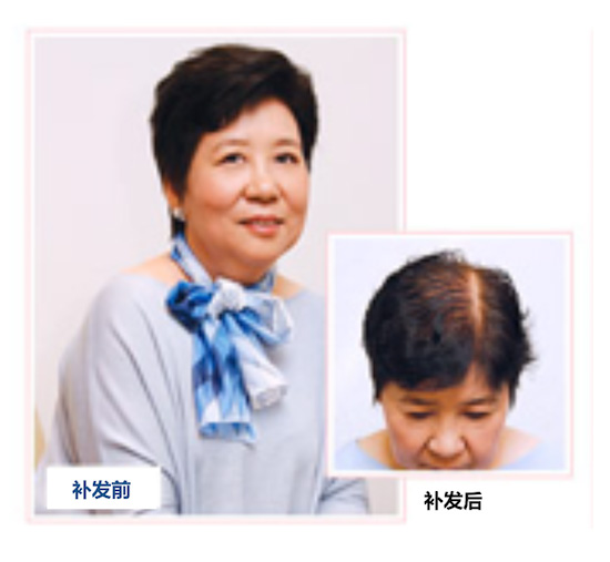 薛太太假发织发补发前后对比图.jpg 薛太太假发织发补发前后对比图.jpg