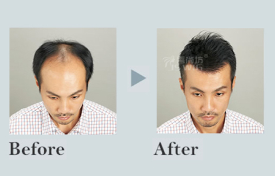 逼真前额补发发际线隐形增发方案