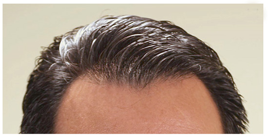什么是头发更换系统简称补发织发2.jpg
