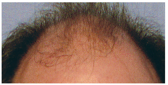 什么是头发更换系统简称补发织发.jpg