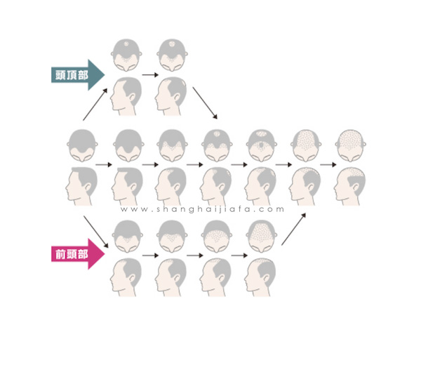 【男性脱发种类有哪些？】男性脱发从大方向来划分只要分为以下几种.jpg