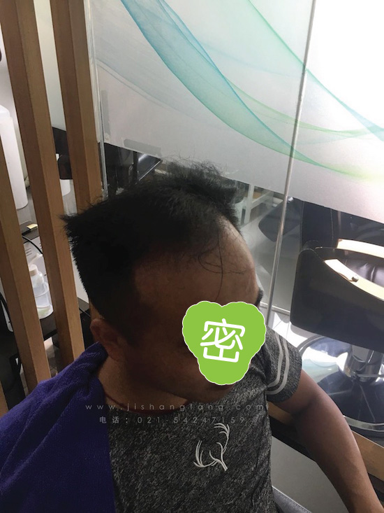 你有勇气掉发十年却没勇气来尝试5.jpg 你有勇气掉发十年却没勇气来尝试5