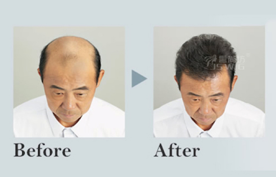 中老年男士超薄发量解决方案