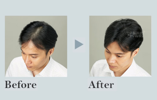 男士脱发头路稀疏解决方案