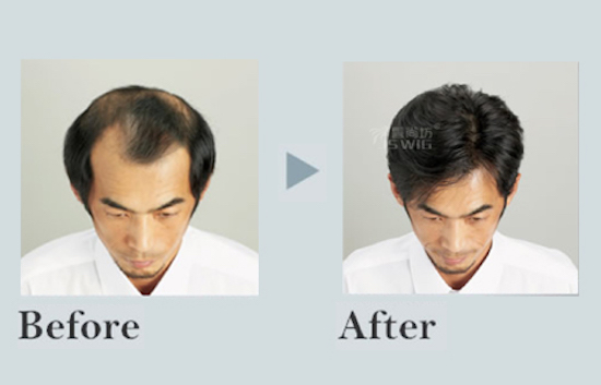 不规则脱发补发解决方案